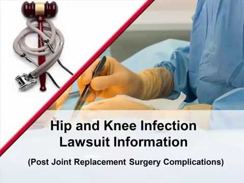 Understanding the Current Landscape of Hip Implant Lawsuit Cases: A Comprehensive Overview