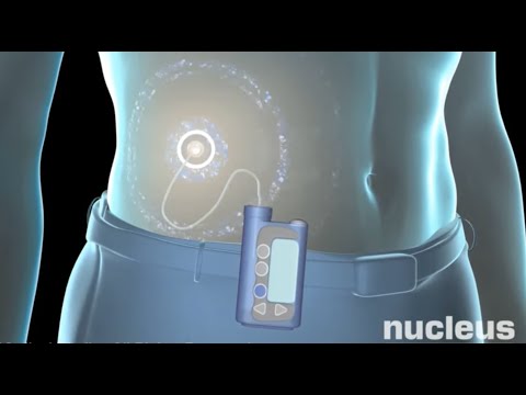 Understanding the Legal Action Regarding the Medtronic Insulin Pump